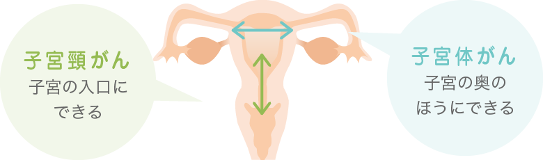 子宮頸がん 子宮の入口にできる 子宮体がん 子宮の奥のほうにできる